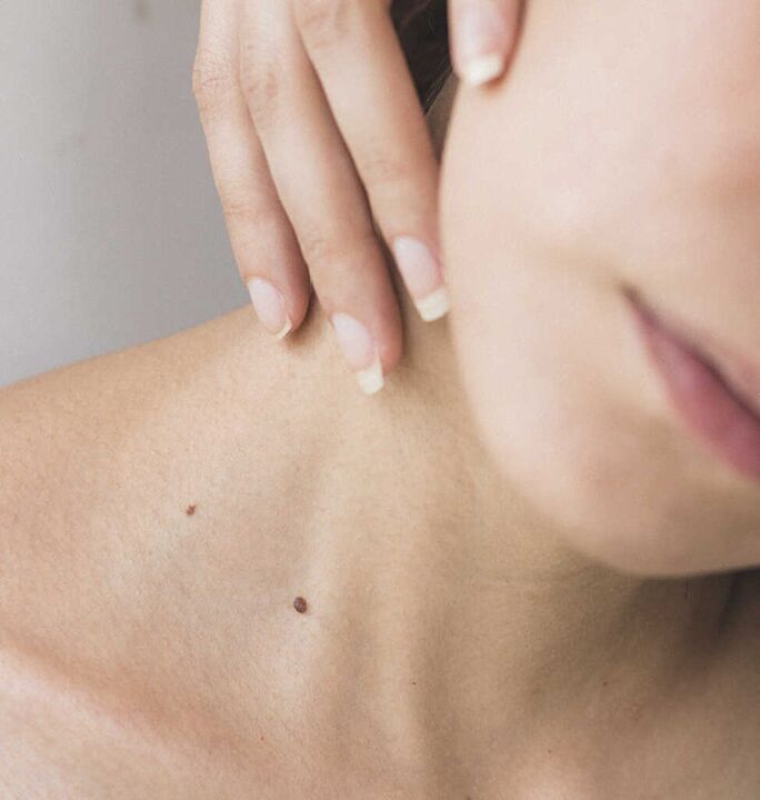 Сковаността на шията е един от симптомите на началния стадий на остеохондроза на цервикалния гръбначен стълб